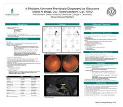 A Pituitary Adenoma Previously Diagnosed as Glaucoma